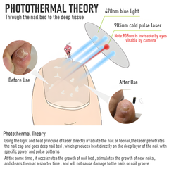 Nail Fungus Laser Device with Light Therapy Effective Onychomycosis Toes Treatment