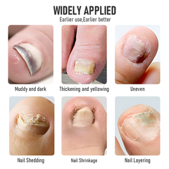 Nail Fungus Laser Device with Light Therapy Effective Onychomycosis Toes Treatment